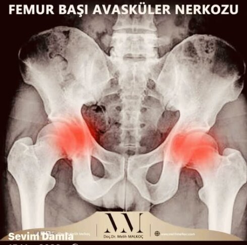 Avasküler Nekroz – Osteonekroz